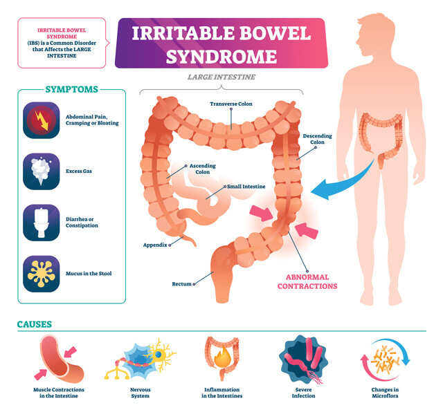 Image result for Beat IBS With 5 Lifestyle Changes infographics