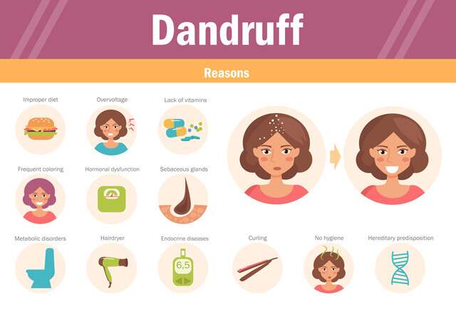 Reasons of Dandruff infographics