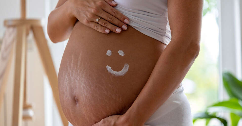Everything To Know About Stretch Marks - Vimarsana News