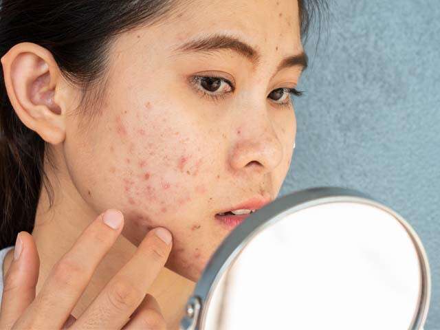Everything To Know About Cystic Acne, And How To Treat It