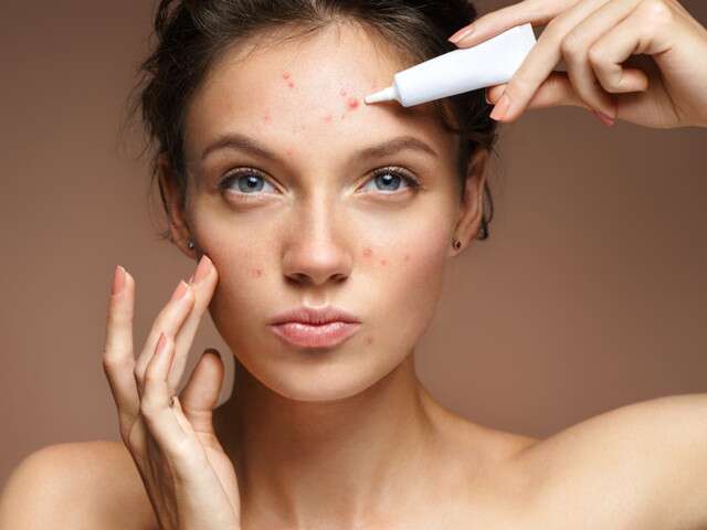 Say Goodbye To Forehead Acne: Tips For Pimple-Free Zone