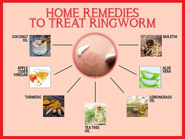 Home Remedies For Ringworm: 10 Ways To Treat