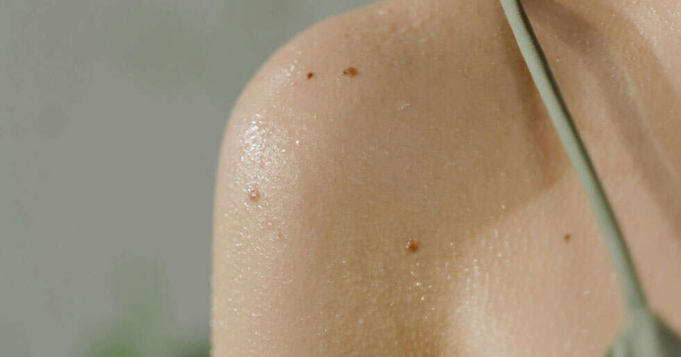 ⁠7 Natural Ways To Calm Heat Rashes This Sweltering Tuesday