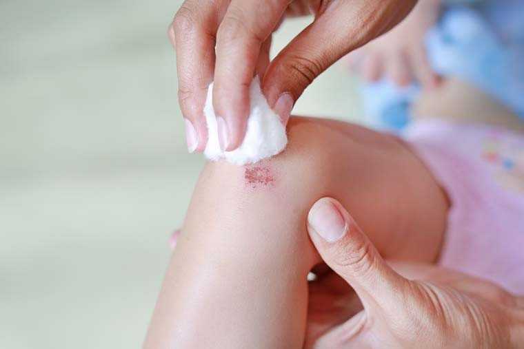 How to treat your child's bruises | Femina.in