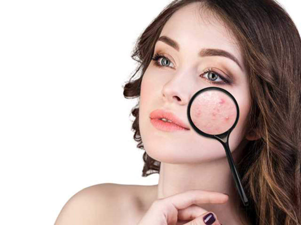 How To Get Rid of Pimples and Prevent Acne Naturally | Femina.in