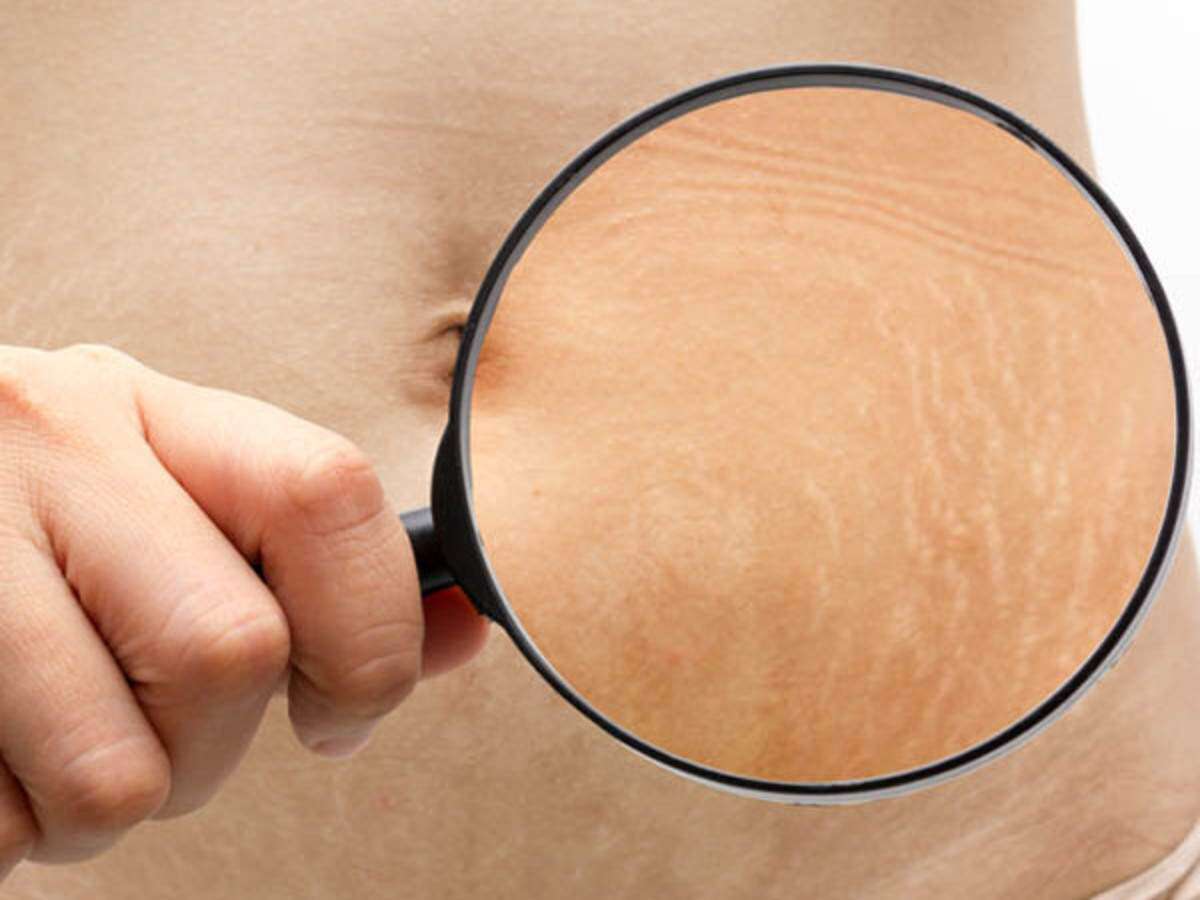 Vi ses Blændende stewardesse How To Get Rid of Stretch Marks with Natural Home Remedies | Femina.in