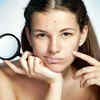 How To Remove Pimple Marks 12 Effective Ways Femina.in