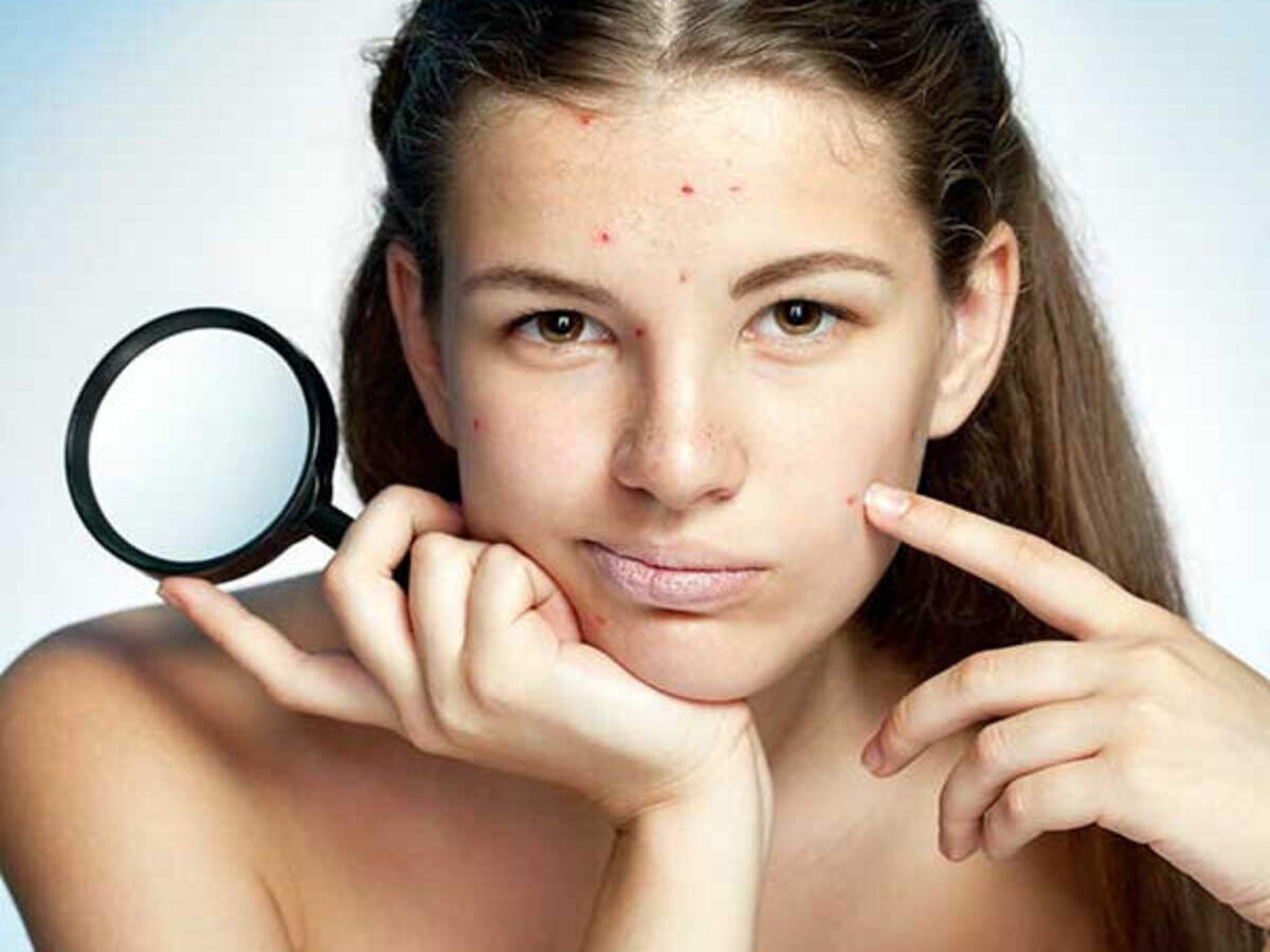 To remove pimples natural methods 15 Natural