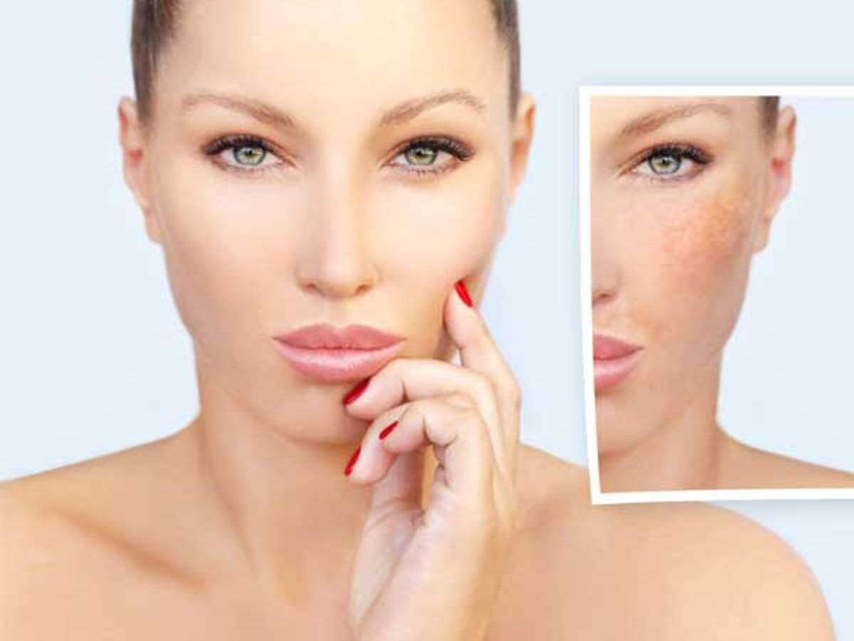 How to Get Rid of Pigmentation Around Mouth Naturally