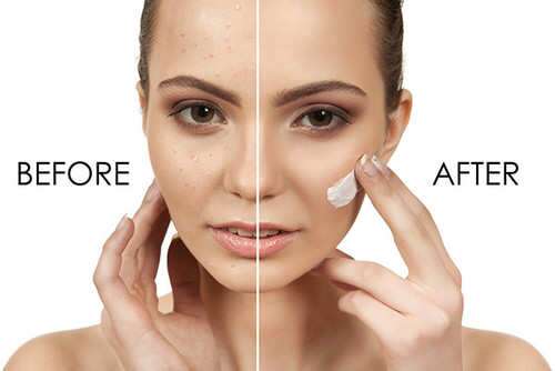 Hautpflege bei Akne