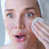 At-Home Tips To Make Stubborn Blackheads Disappear Femina.in