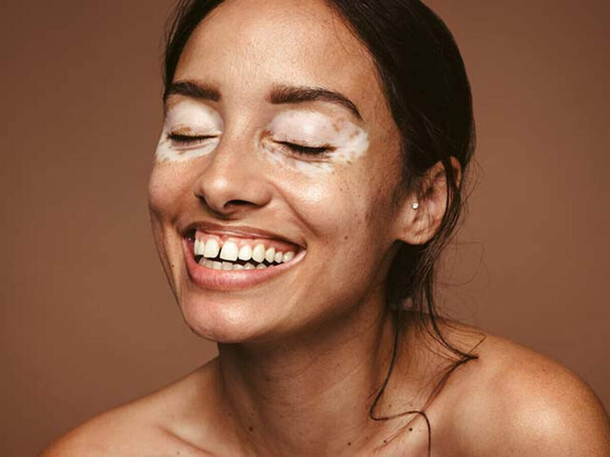 Causes Of White Spots On Face And How To Manage Them 55 OFF how-to-remove-black-spots-dark-spots-acne-scars-on-face-only-in-5