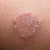 Ringworm: Symptoms, Pictures, Treatment, Diagnosis, and More