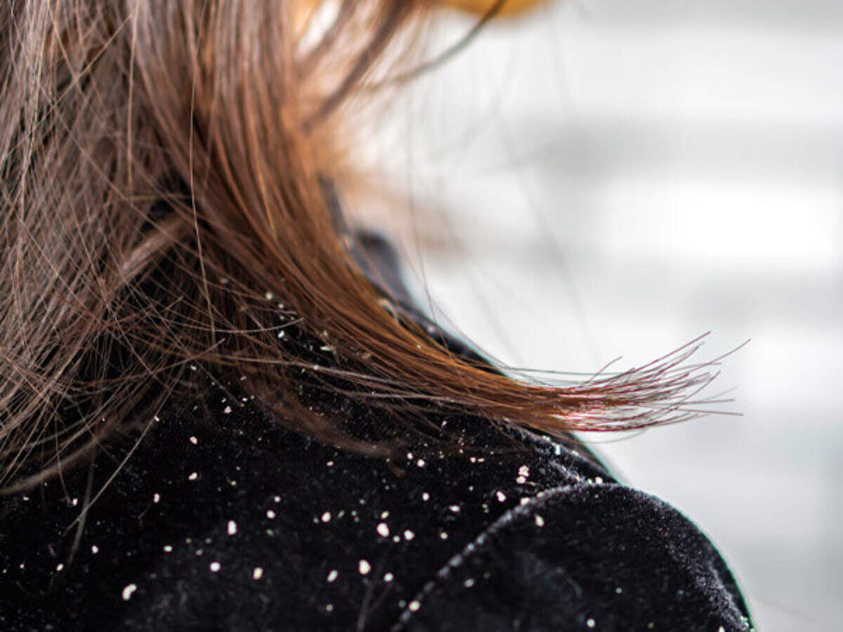 Home Remedies For Dandruff And Itchy Scalp Home Remedies For Dandruff And Itchy Scalp