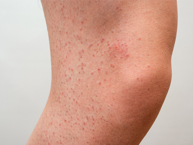 How to Get Rid of Red Bumps on Thighs: Achieve Smooth, Radiant Skin!