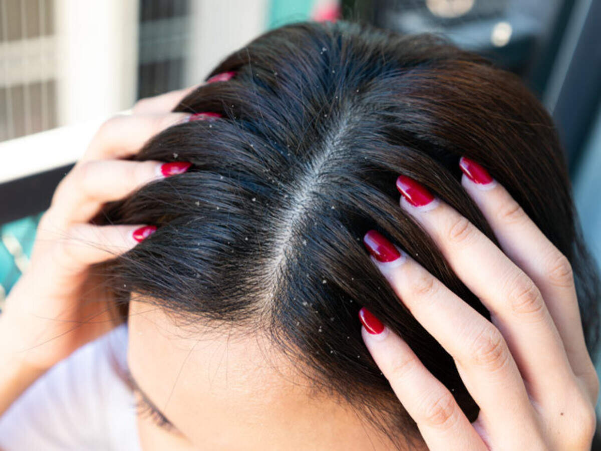 Reasons For Dandruff: Symptoms And Remedies To Get Rid Of It Reasons For Dandruff: Symptoms And Remedies To Get Rid Of It