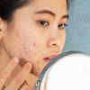 Everything To Know About Cystic Acne, And How To Treat It Femina.in pic